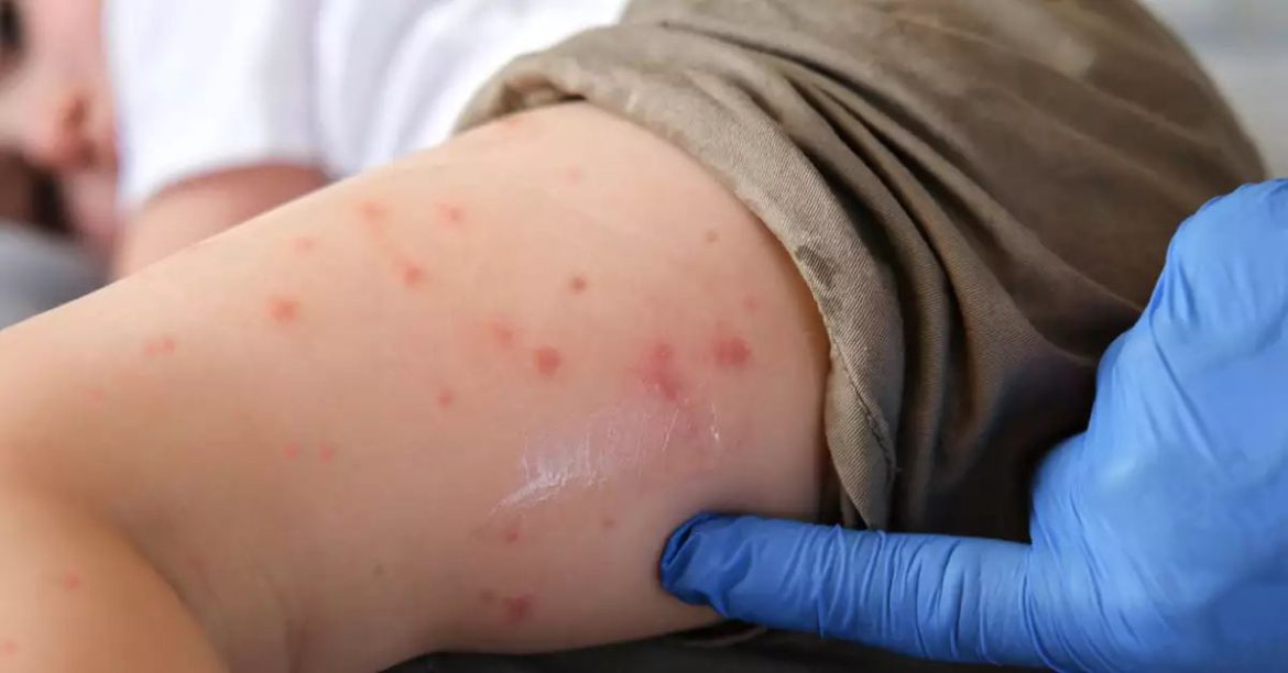 Sarampión en México: riesgos, causas y la importancia de la vacunación